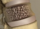 Osteoporosisos csontszövet